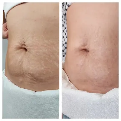 Trzcinka Estetycznie